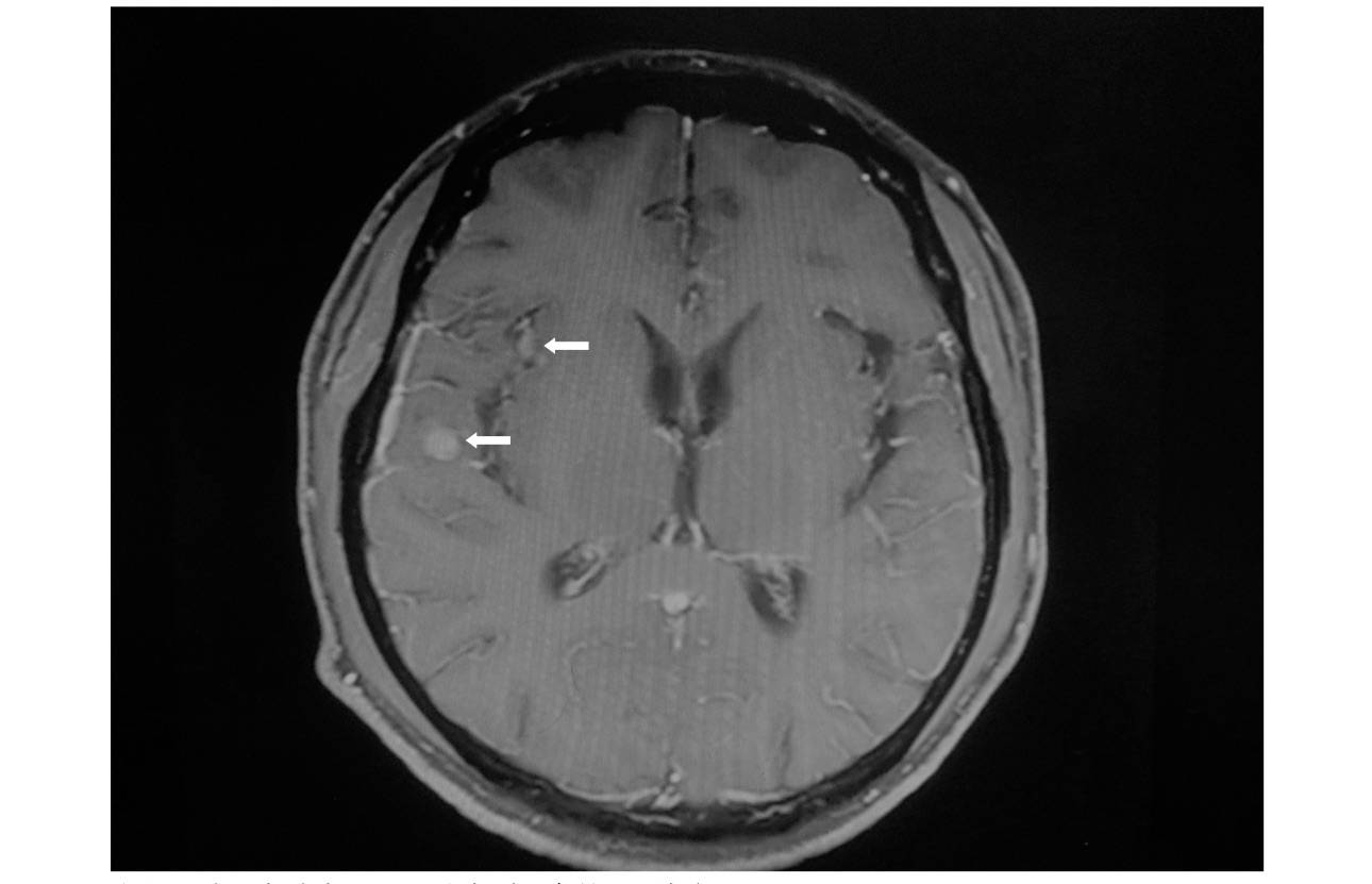 科普恶性肿瘤脑转移怎么办神经外科微创手术有奇效
