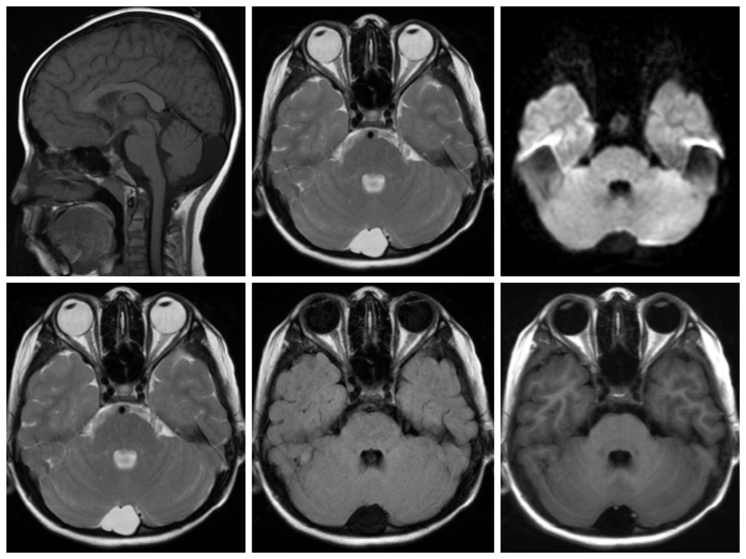 如何鉴别—大枕大池与枕大池蛛网膜囊肿