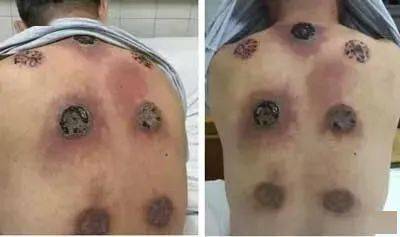 凡生癌症者三焦皆不通附动态图片演示三焦疏通法