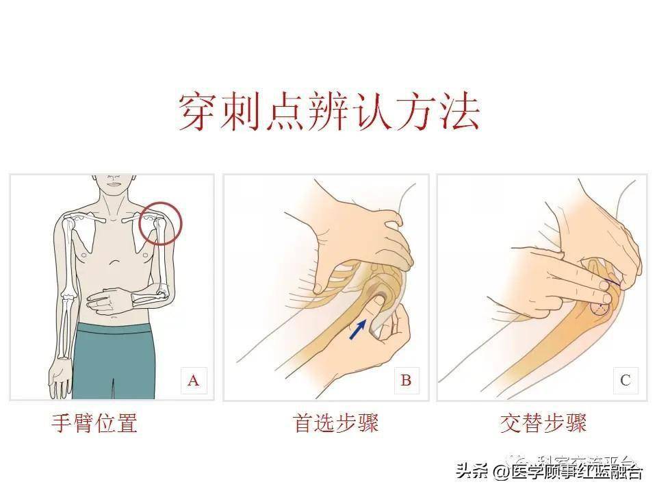 骨髓穿刺输液技术在沙漠直升机救援的应用