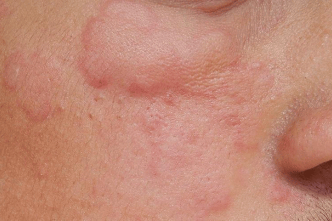 关于碘造影剂过敏反应你知道多少