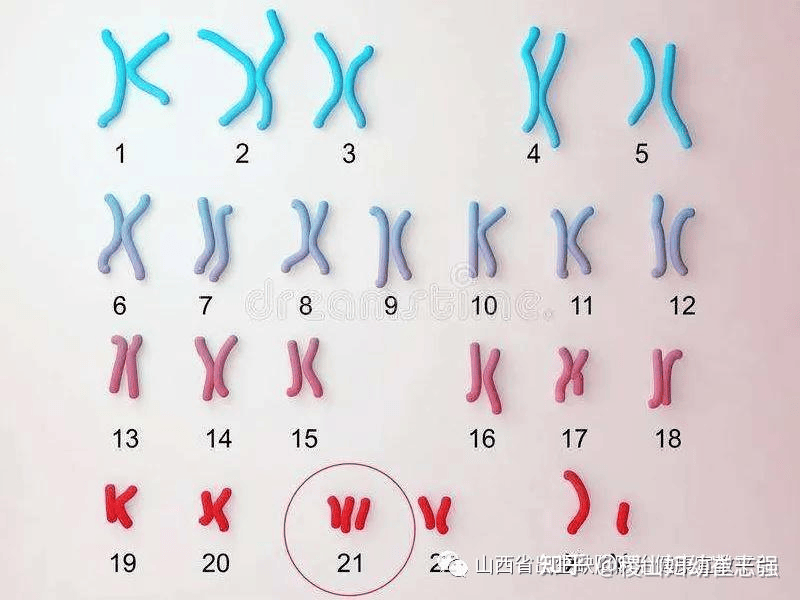 13三体综合征染色体图片