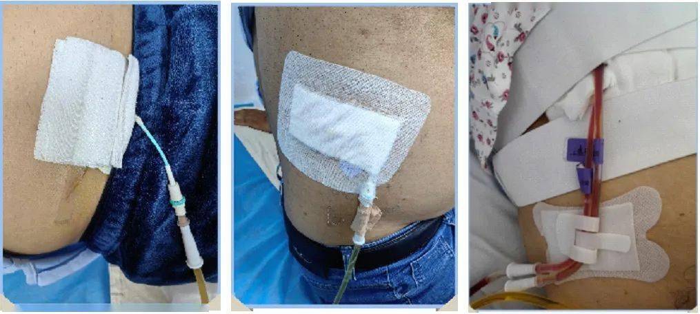 管注细节手护有道科室ptcd管道规范化管理经验分享