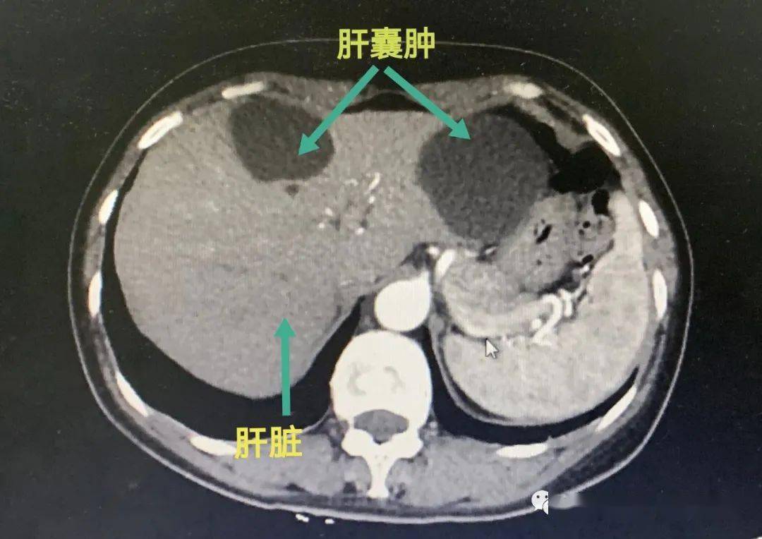 肝囊肿是怎么回事图片