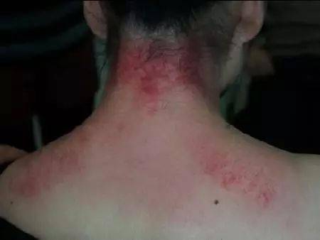 背部刮痧可以看出一个人的身体健康状况