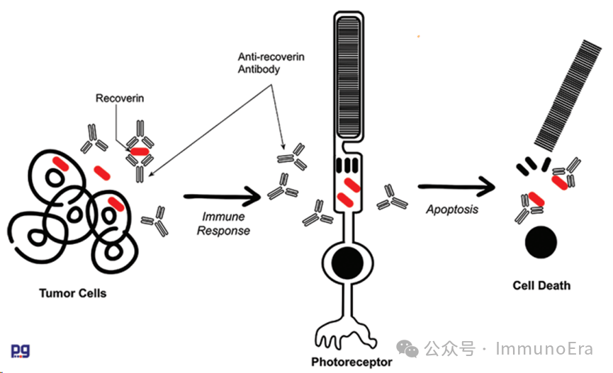 neuroretinopathy图片