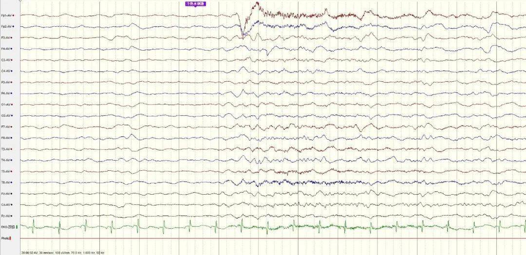 不正常脑电图图片