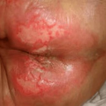 处理失禁性皮炎,劝你别用爽身粉!