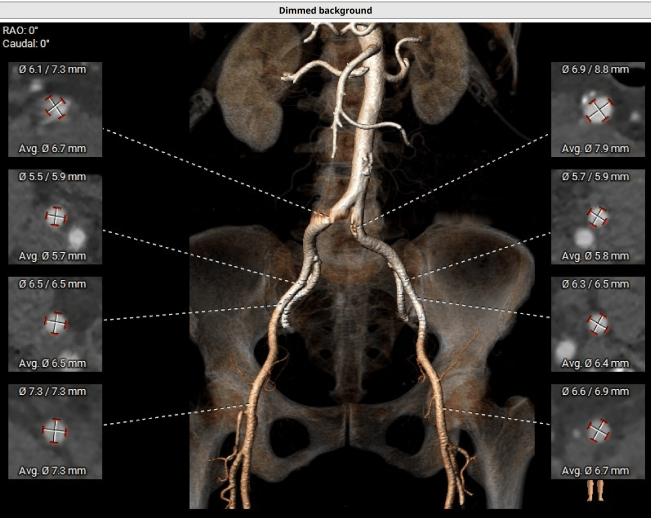 新闻快递心内二科两例高难度tavr手术为患者打开心门
