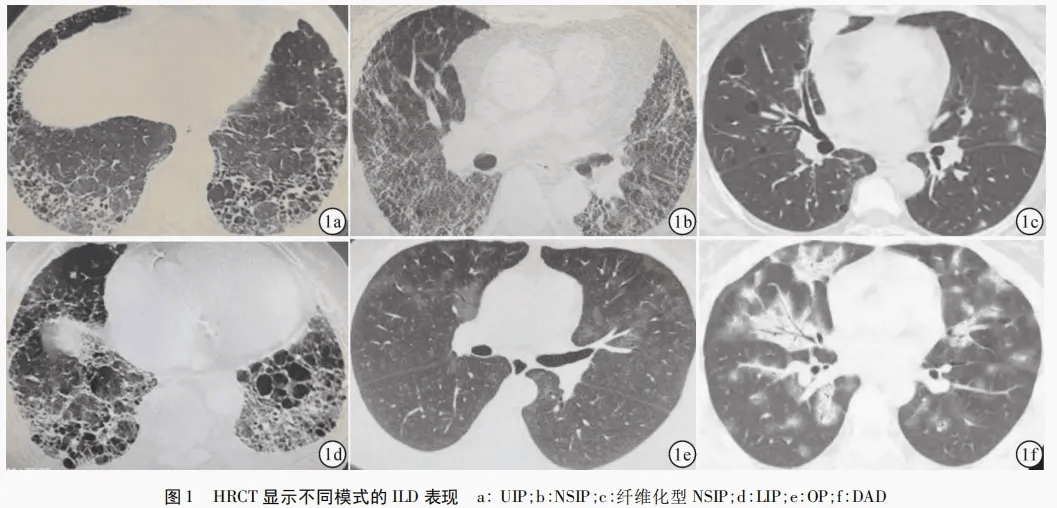 指出 已知或未知病因的经影像学证明为肺纤维化的 ild 患者