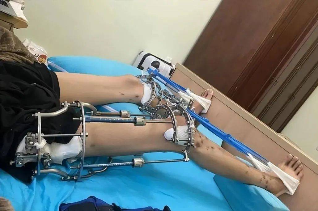 20岁北京男孩李亚诺,花16万断骨增高7.2厘米,后来怎样了?