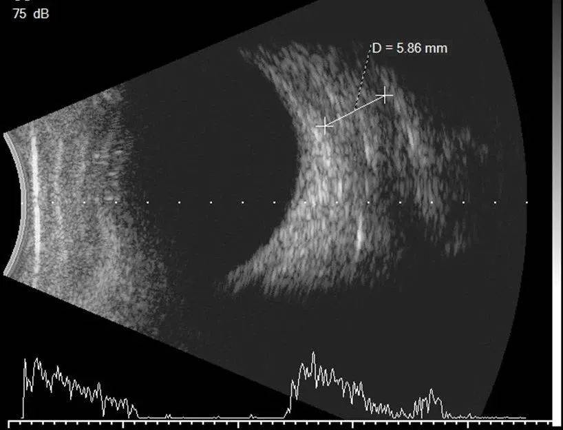 带您了解眼部b超