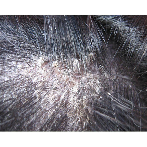 头皮瘙痒洗什么洗发水除螨去屑洗发水推荐