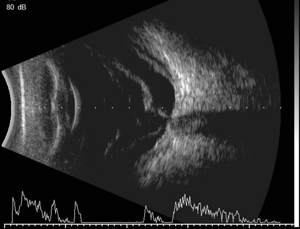 带您了解眼部b超