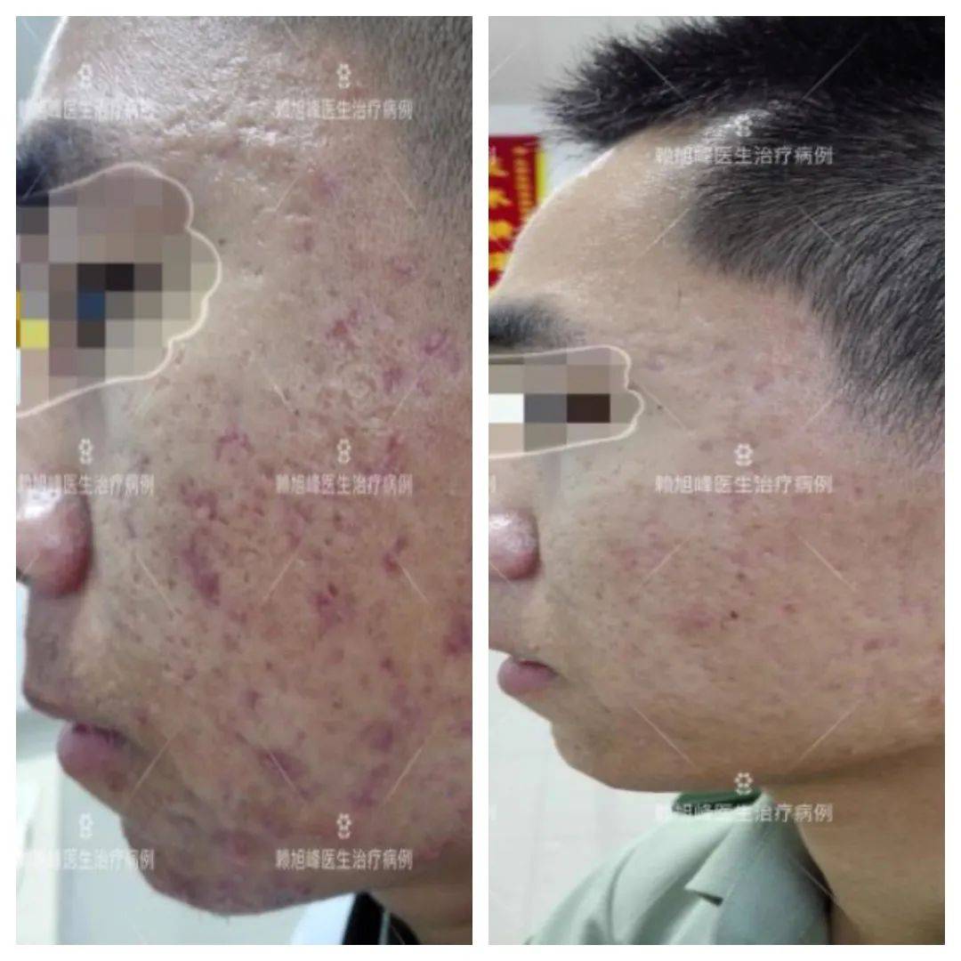 优秀案例展示瘢痕疙瘩注射治疗前后临床效果对比.