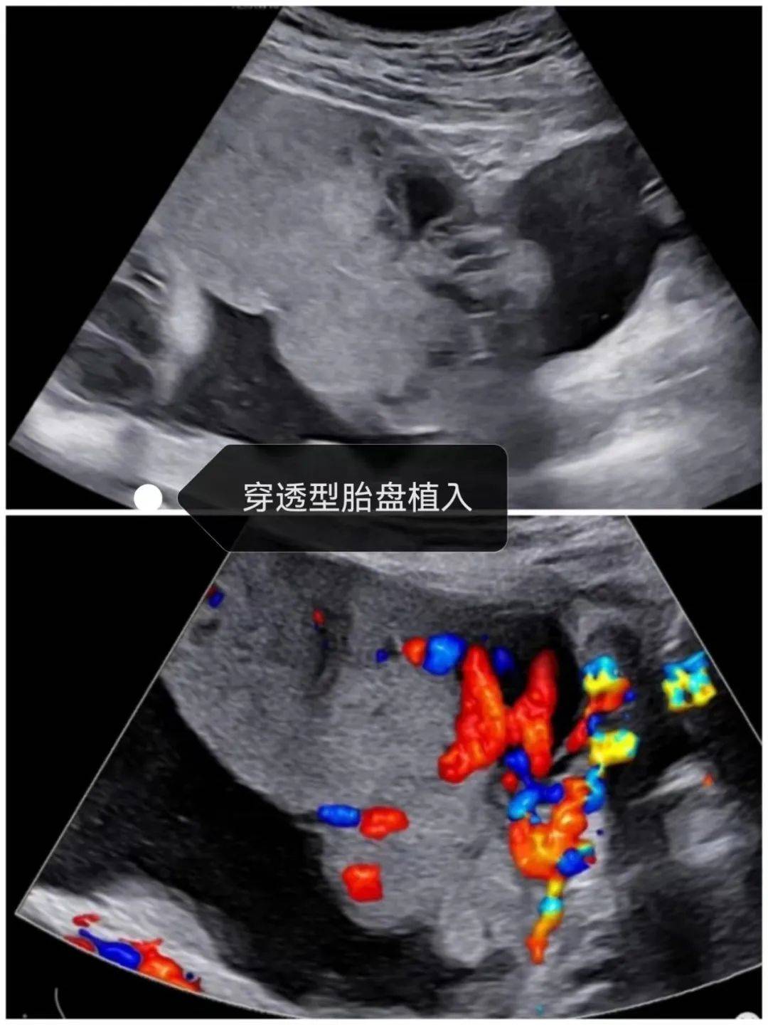 胎盘图片超声图片