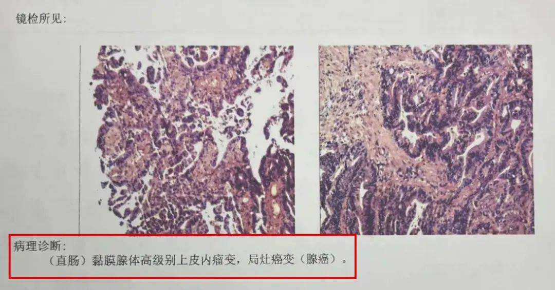 明明很重视养生却被确诊癌症医生这个吃饭习惯害了她