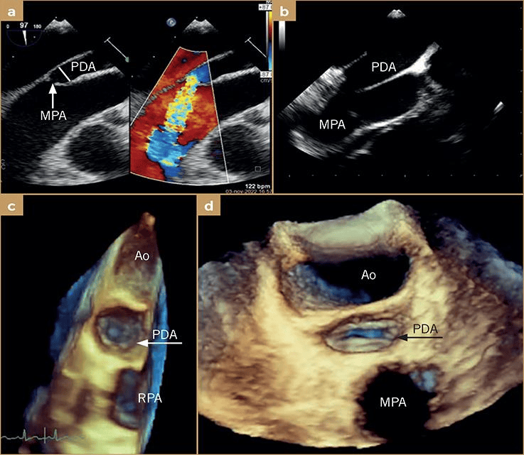 a) 经食管超声心动图(tee),带和不带彩色多普勒,2b型,指状动脉导管未