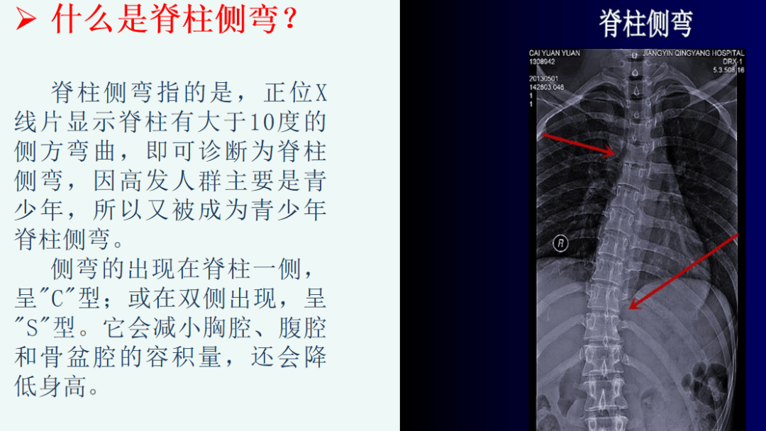 任丘教体局联合卫健局发力让孩子们挺直腰板