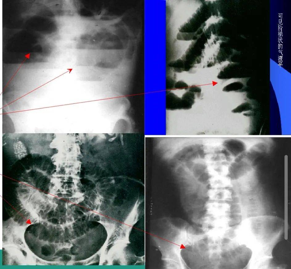 普通外科医生:谈肠梗阻的那些事