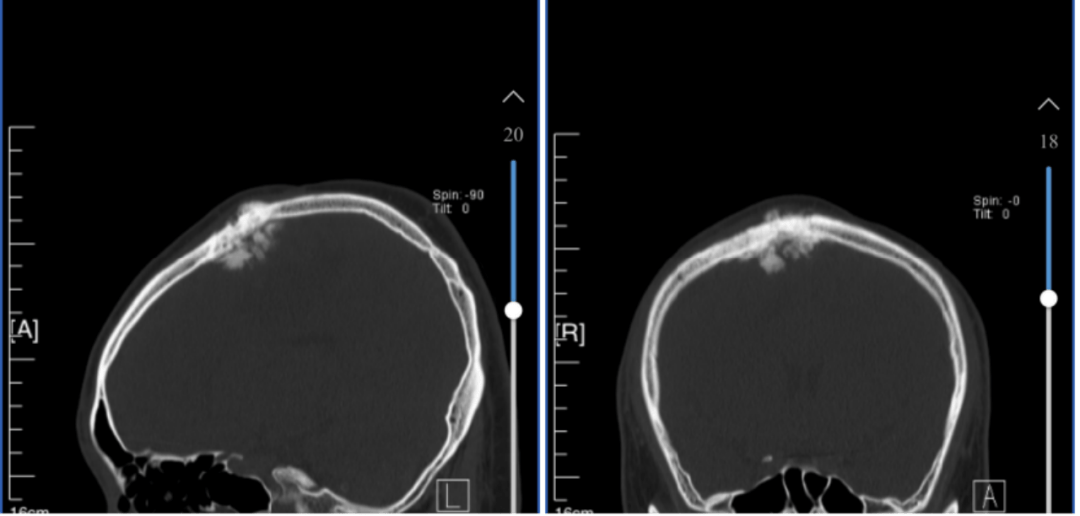 然而不幸的是,今年1月份,小刘门诊复查头部3d-ct,提示局部颅骨及颅内