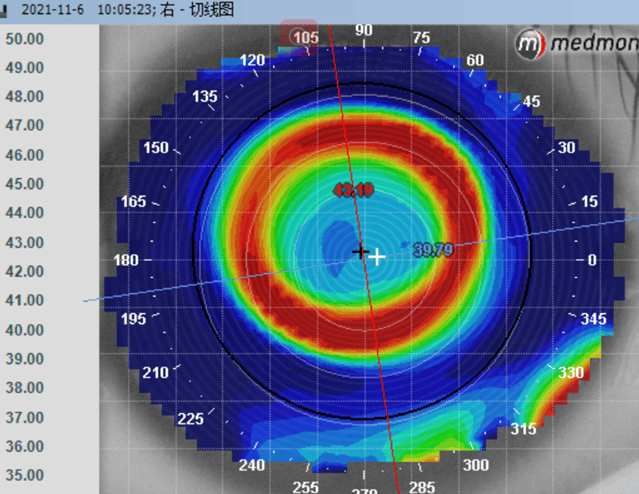 角膜地形图高度图分析图片