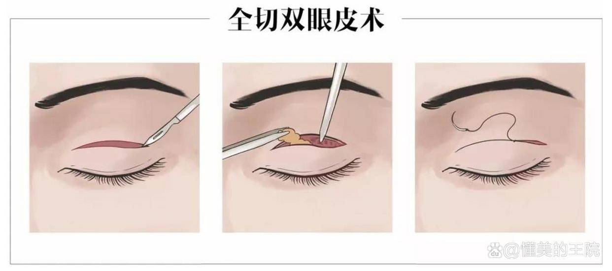 呼和浩特市割双眼皮美丽蜕变之路