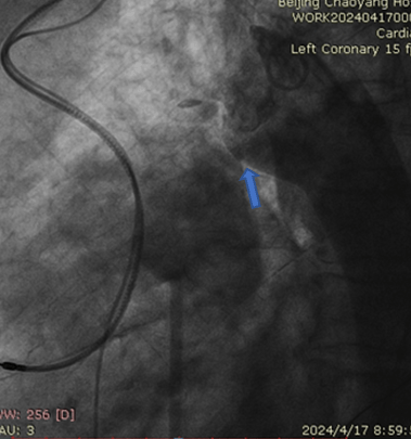 【朝医新闻】心脏中心实施一站式经导管主动脉瓣置换联合动脉导管未闭封堵术手术