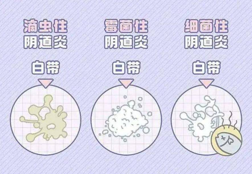 豆腐渣分泌物长啥样图片