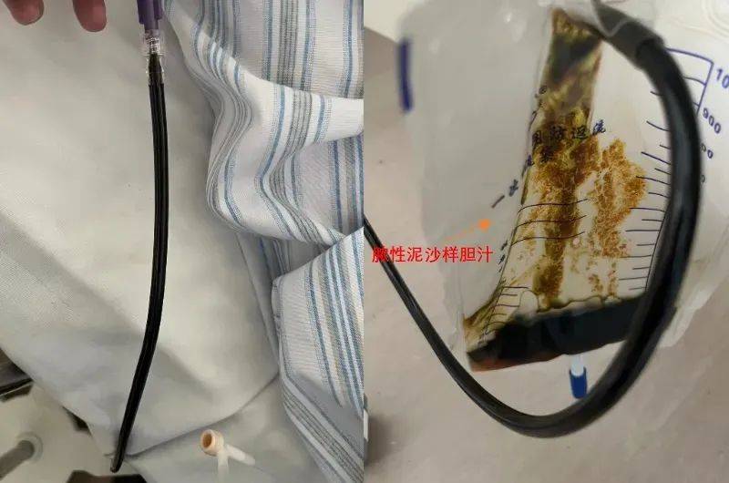 北京怀柔医院消化内科应用ercp技术成功救治九旬急性化脓