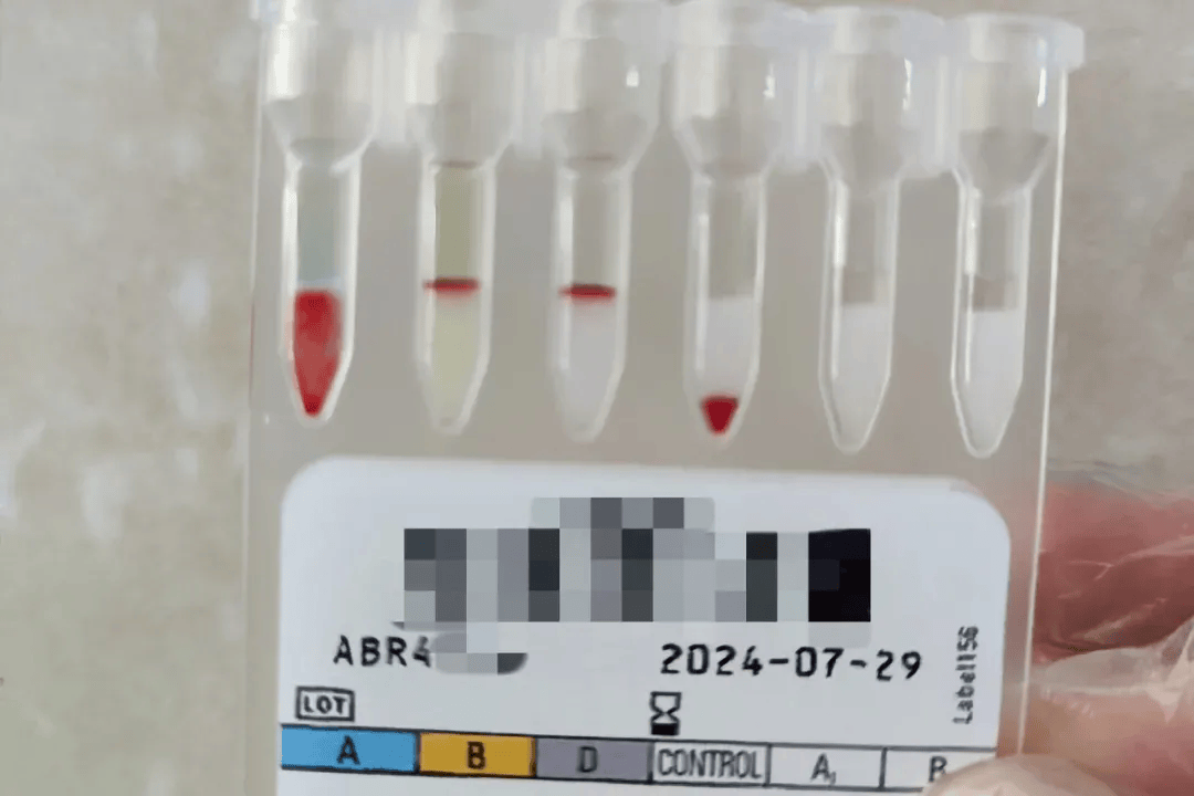 极为罕见!_血型_孟买_患者