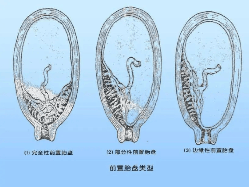 科普在线 区分胎盘低置和前置胎盘