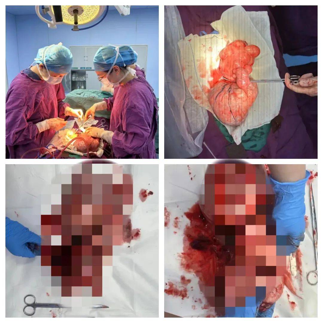 诸暨一女子,肚子挖出5斤"炸弹"