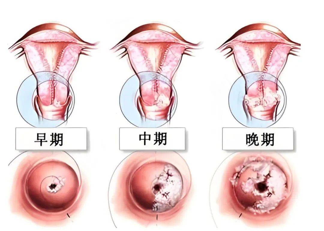 宫颈癌常见早期症状5未定期进行宫颈癌筛查4