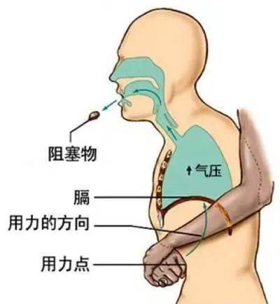 海姆_异物_老人