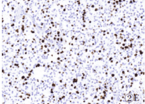 伴IDH1 R82K突变的复发性胶质瘤1例并文献复习