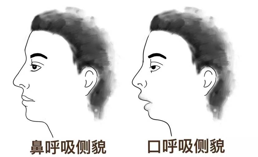 科普|孩子张着嘴呼吸,真的会变丑吗?_下颌_状态_问题