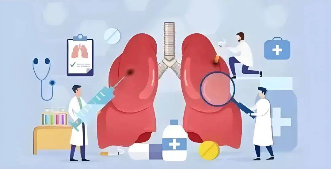 科普小课堂丨体检发现肺结节怎么办?