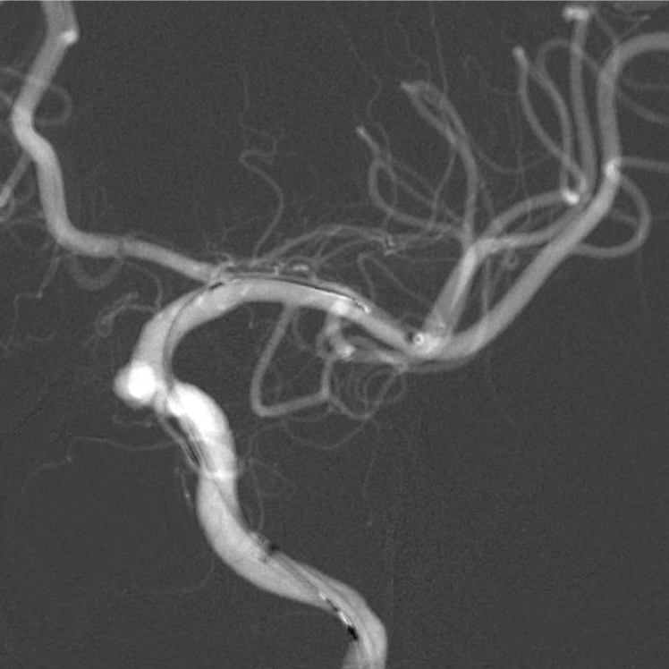 焕密网新生|海南首秀-高振忠教授团队:颈内动脉中小动脉瘤血流导向