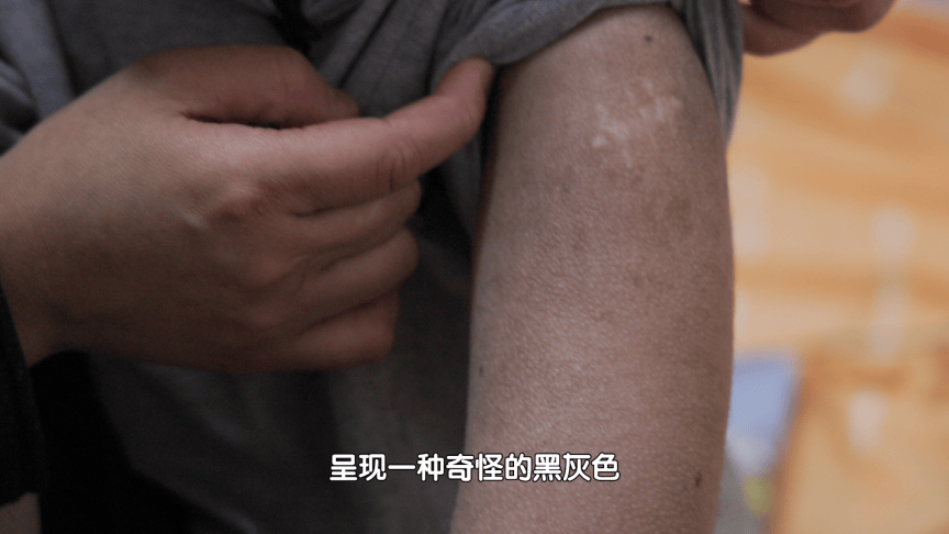 【生命缘】9岁男童患罕见病6年内做4次手术 颈部肿瘤突然增大扼住命运