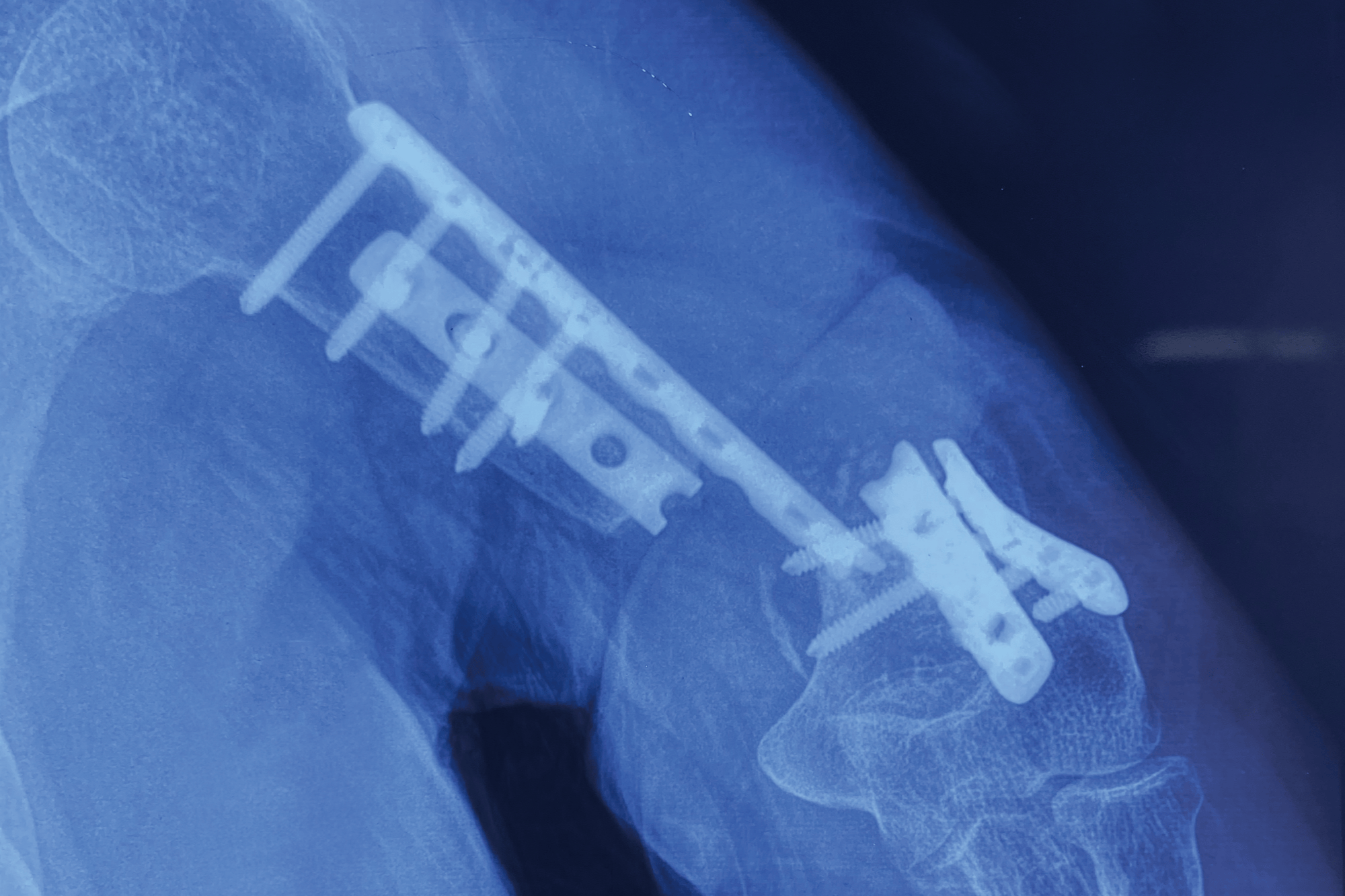 骨折钢板屡次断裂 娄底市中心医院为患者打印新骨头