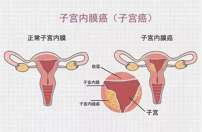 警惕!阴道不正常排液,可能是子宫内膜癌的信号_治疗_患者_手术