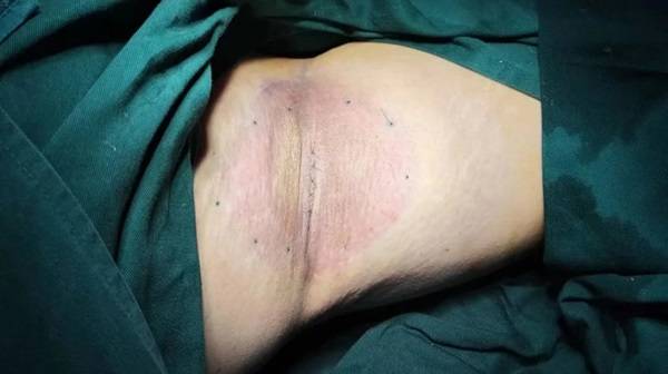 打浦桥社区医院外科率先在居民家门口开展了体表痣切除术,脂肪瘤切除