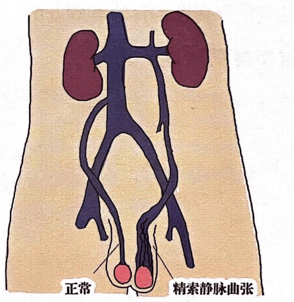 男性生育的潜在"杀手"