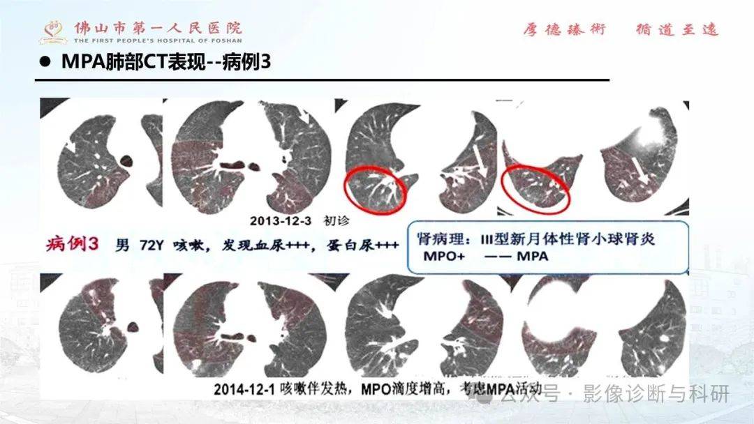 【ppt】anca相关性血管炎分类及肺部ct表现