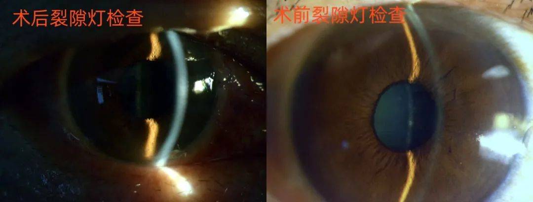 "感谢人民医院,感谢倪博士,这次手术后,我右眼视力现在比左眼视力还好