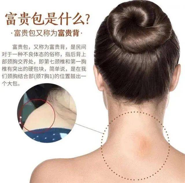 脖子粗,肩膀宽,胸背厚,不是胖!是淋巴堵了,该做肩颈疏通了!