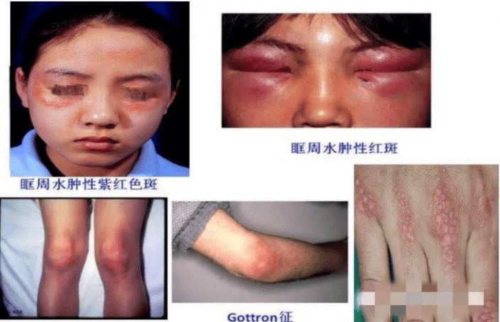观疹识病| 一文教你识别不同风湿免疫病的皮疹表现