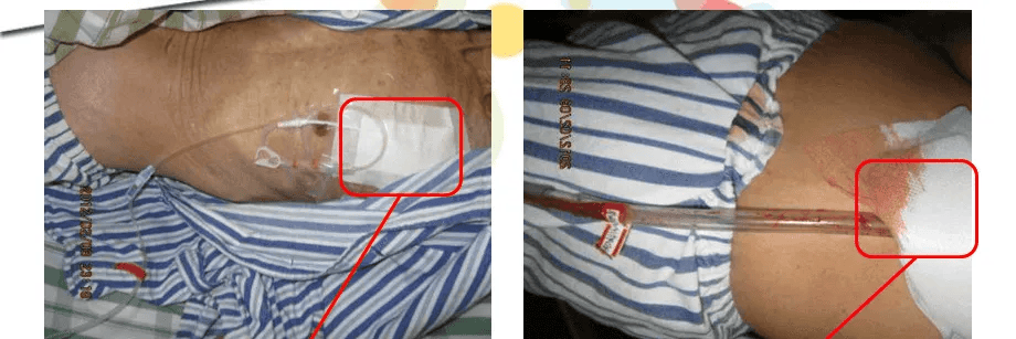 胸腔闭式引流护理4腹腔感染一旦腹腔引流液由淡红或淡黄的清亮液变为