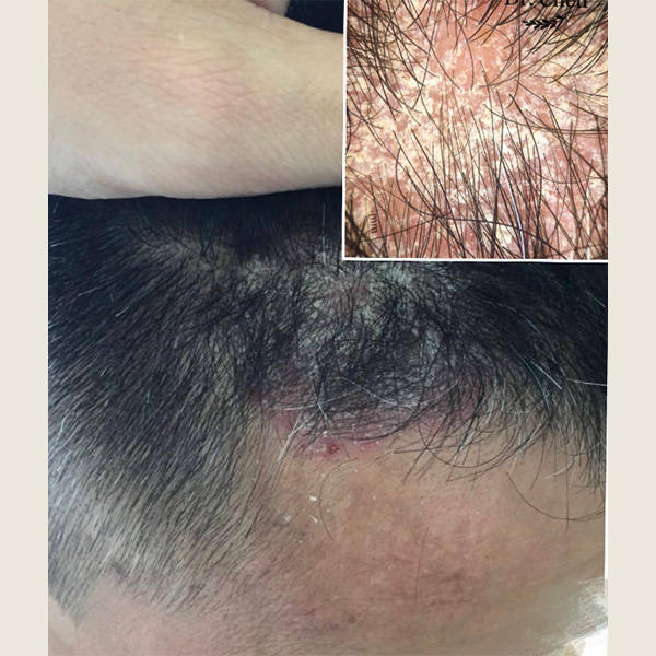 它采用了一系列高效的成分,包括二硫化硒(0.9%),oct(0.9%)和水杨酸(0.